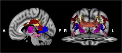 White Matter Correlates of Hostility and Aggression in the Visuospatial Function Network in Patients With Schizophrenia